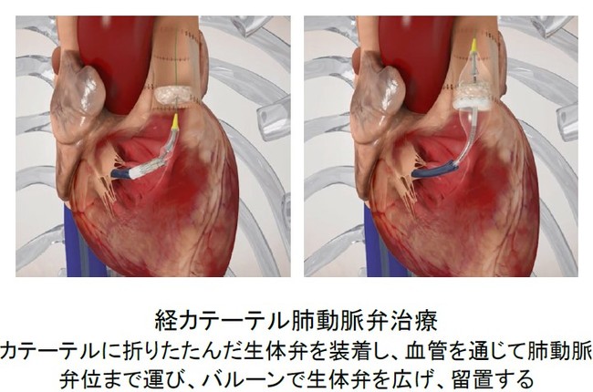 日本初の経カテーテル肺動脈弁治療 機能不全に陥った生体弁の置換 が成功 エドワーズの経カテーテル生体弁が 先天性心疾患 ニコニコニュース