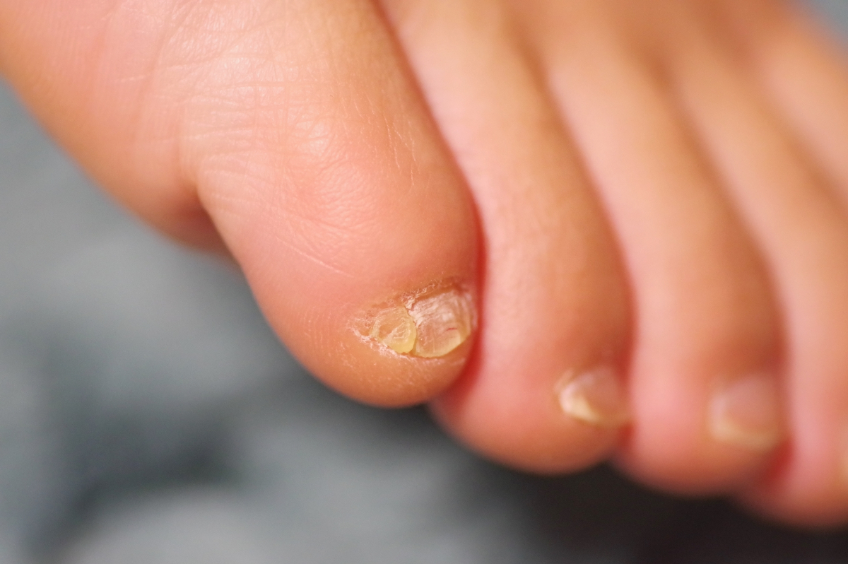 「足の小指の爪」がよく剥がれる…なぜ？ 2枚に分かれて生える原因は？ 対処法を皮膚科医が解説 | ニコニコニュース