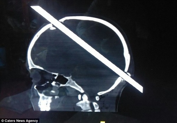 これは痛い 工事現場で落下した男性 鉄の棒が脳に突き刺さる 奇跡的に命に別状なし ニコニコニュース