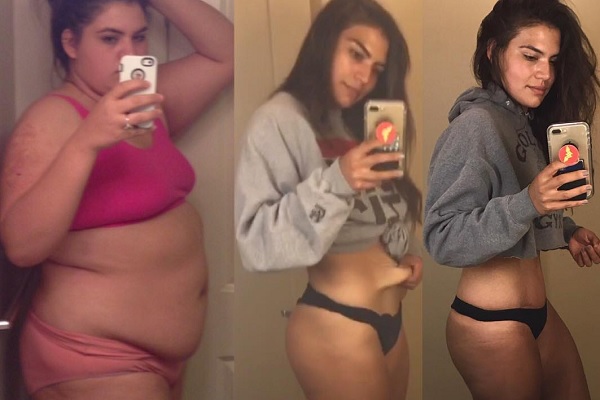 136キロだった代女性がダイエットで変身 余った皮膚の切除痕も 誇り ニコニコニュース