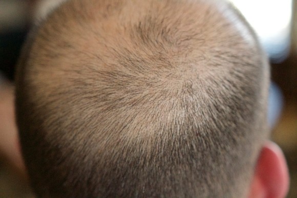 新たに承認された皮膚炎治療薬に思わぬ発毛効果 全頭性脱毛症の少女の髪の毛が劇的に生える 米研究 ニコニコニュース