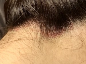 頭皮の赤い斑点の原因は ニコニコニュース