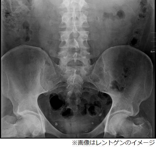 手術で 健康な睾丸 を誤摘出 父親になれない と病院を提訴 ニコニコニュース 手術で 健康な睾丸 を誤摘出 父親になれない と病院を提訴 ニコニコニュース