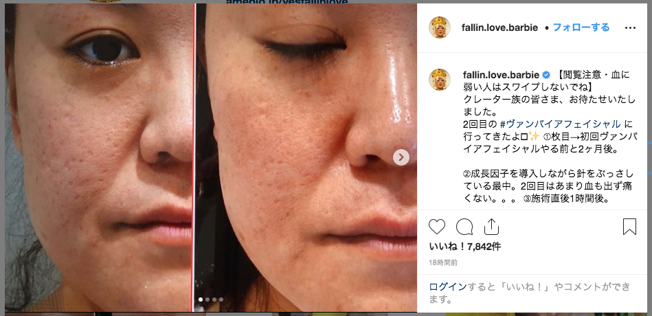 痛そう バービー 美容法による肌の変化を自らレポート 身体を張って美を追求する姿勢に称賛の声 ニコニコニュース