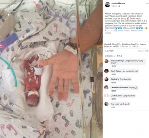 369グラムの赤ちゃん 元気に産声をあげて誕生 米 動画あり ニコニコニュース