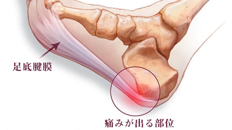 足底腱膜炎という症状をご存知ですか ニコニコニュース