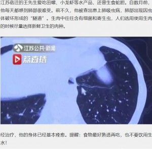 カニ好きの男性 肺に細長い寄生虫が発見される 中国 ニコニコニュース