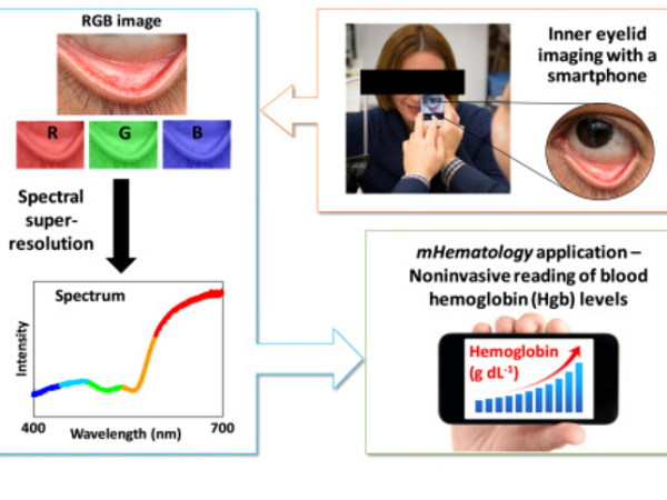 まぶたの写真を撮って貧血を診断 パデュー大らがスマホアプリによる検査技術を開発 ニコニコニュース