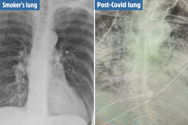 コロナ感染者の肺のレントゲン画像 喫煙者よりもヤバイと話題に ニコニコニュース