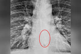 注意喚起 30代男性が就寝中に Airpods を誤飲し窒息寸前に ニコニコニュース